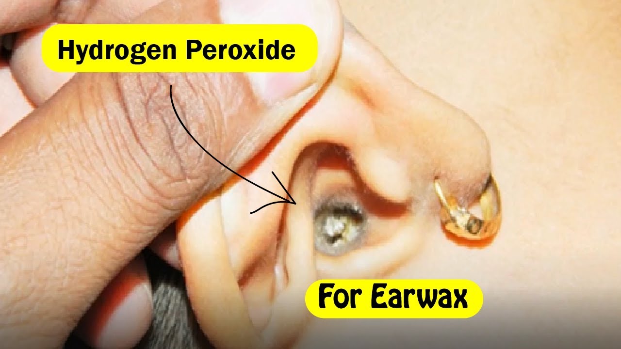 Is Hydrogen Peroxide Safe to Put In Your Ears?