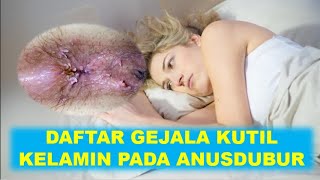 DAFTAR GEJALA KUTIL KELAMIN PADA ANUS DUBUR