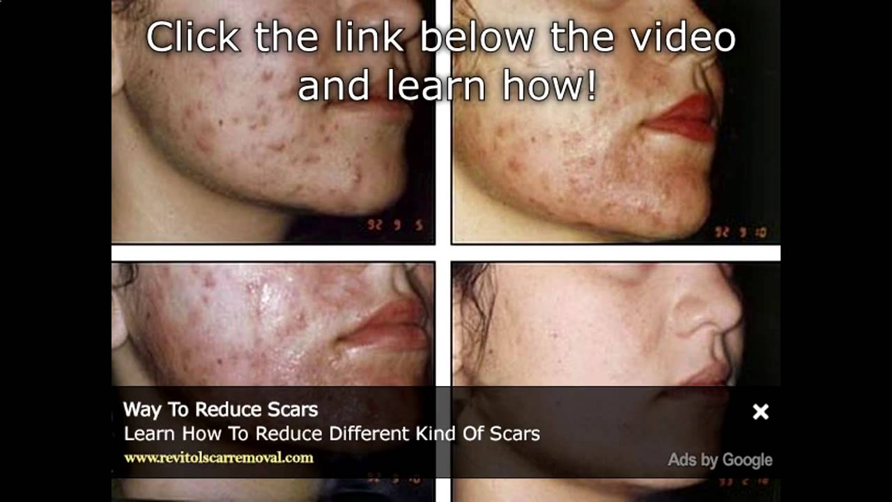 How To Get Rid Of Under Hide Pimple Quickly How To Get Rid Of Under Epidermis Pimple Quickly