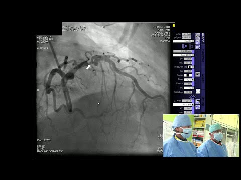 Video: Rozdíl Mezi Bypassem A Otevřenou Operací Srdce