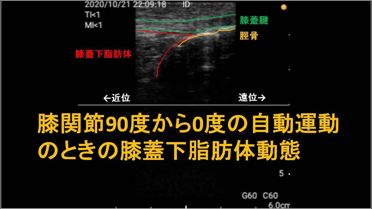 膝蓋下脂肪体動態 右 長軸画像 膝関節90度から0度の自動運動 Ept Note 膝蓋下脂肪体動態 右 長軸画像 膝関節90度から0度の自動運動 Ept Note