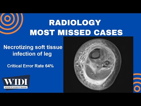 Most Missed Cases: Necrotizing soft tissue infection of leg