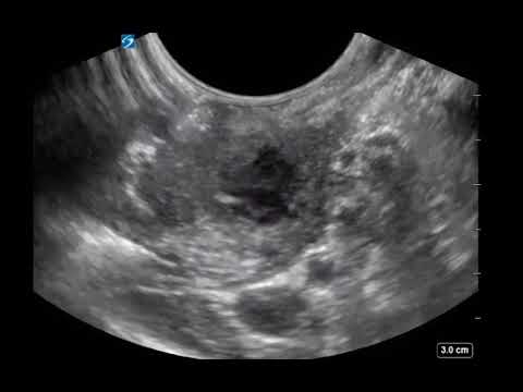 Right Peritonsillar Pain and Swelling - Immediate Fix with POCUS