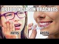 ORTODONCIA INVISIBLE SIN BRACKETS 🦷 Precio INVISALIGN PERU 🤩 SANTIAGO BURGA 3D digital dental design