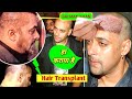 Salman khan baldness full journey of hair transplant  bollywood celebrity hair transplant in india