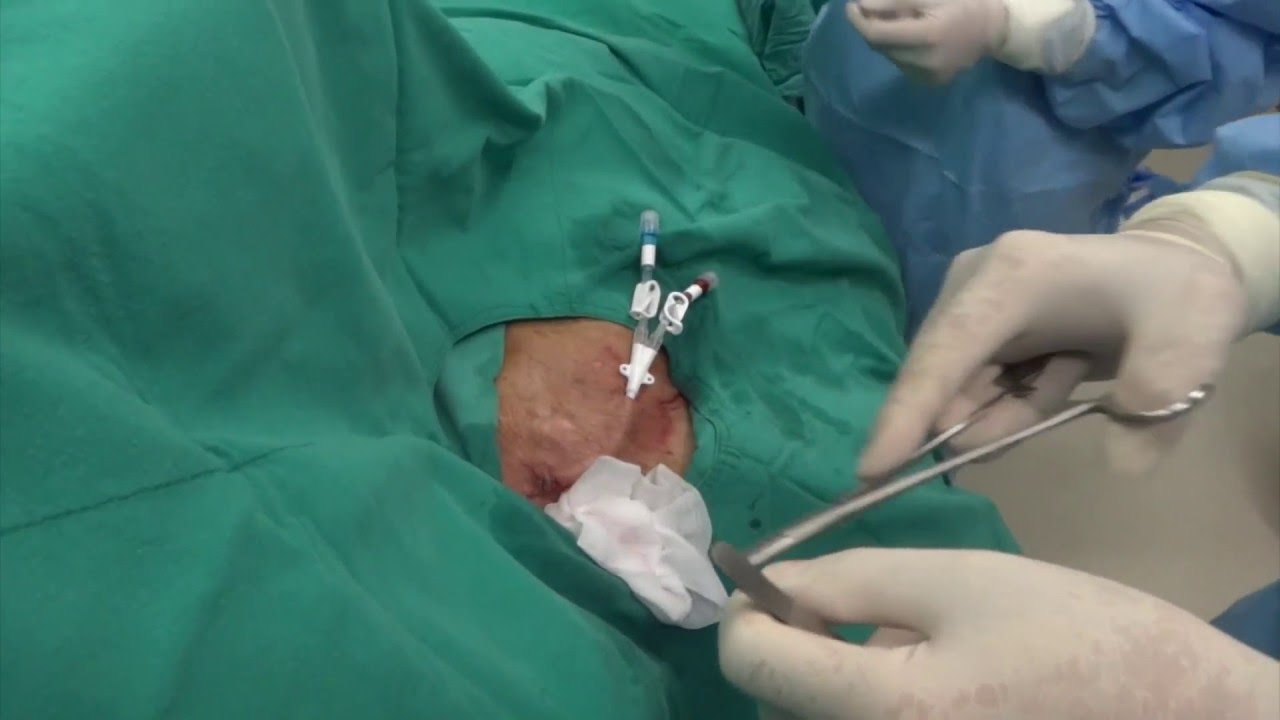 Palindrome Cath Insertion Youtube Palindrome Cath Insertion Youtube