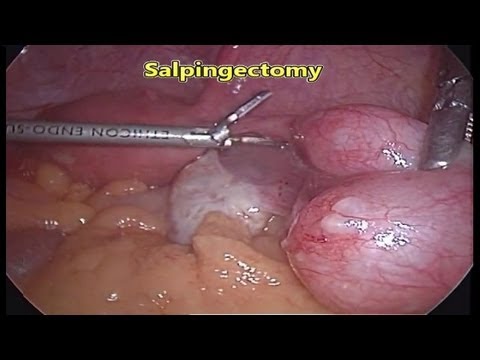 laparoscopic tubal salpingectomy ectopic