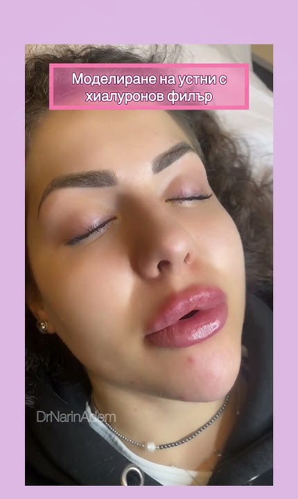 Lip filler after De Narin Adem, моделиране на устни с хиалуронов филър ...