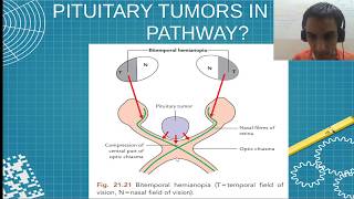 MBBS AN30.5 Pituitary Tumors in Visual Pathway | Sudharshan PB