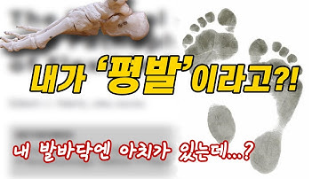 많은 사람들이 자신이 평발인지 모르고 산다?!