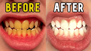 How I Whitened My Teeth in 14 Days!