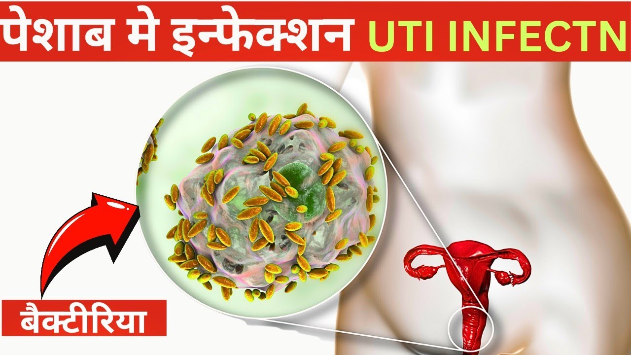 Uti Rajya UTI INFECTION(यूरिनरी ट्रैक्ट इन्फेक्शन )|uti infection ke laksan||uti ...