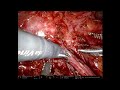 V01-01: Robotic ureteral reconstruction of non-absorbable clip erosion into the ureter