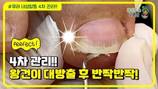 [잘못된컷팅3] 보기만해도 속 시원~해지는 내성발톱 관리! 꾸준하게 방문하셔서 정말 많이 좋아지셨어요~~ / Ingrown toenail
