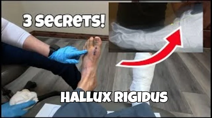 Hallux Rigidus Surgery: The Top 3 Secrets You NEED To Know
