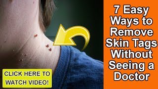 7 Easy Ways to Remove Skin Tags Without Seeing a Doctor!