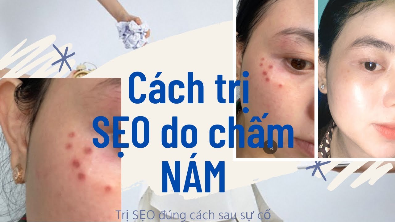 ĐỐT TÀN NHANG bị SẸO phải làm sao ?| SAI LẦM khi TRỊ... - youtube