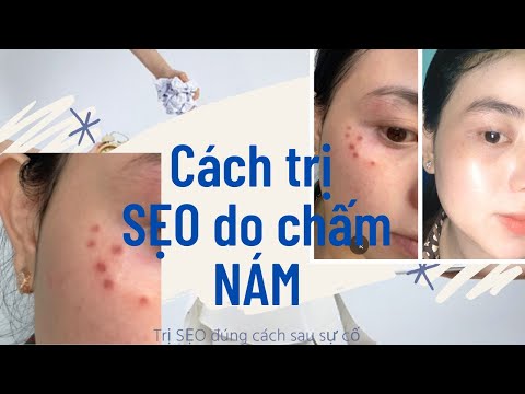 Video ĐỐT TÀN NHANG bị SẸO phải làm sao ?| SAI LẦM khi TRỊ... - youtube