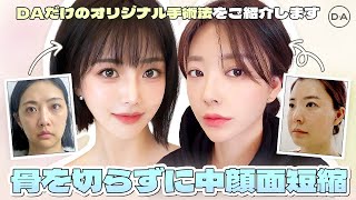 韓国整形］骨を切らずに中顔面を短縮！DAだけのオリジナル手術法のご
