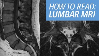 How I Read an MRI of the Lumbar Spine: Sequences, Search Pattern and Example Cases Explained