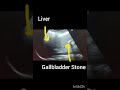 Ultrasound of liver! Gallbladder Stone! Cholelithiasis! #ultrasoundmadeeasy86#radiology#viralshort