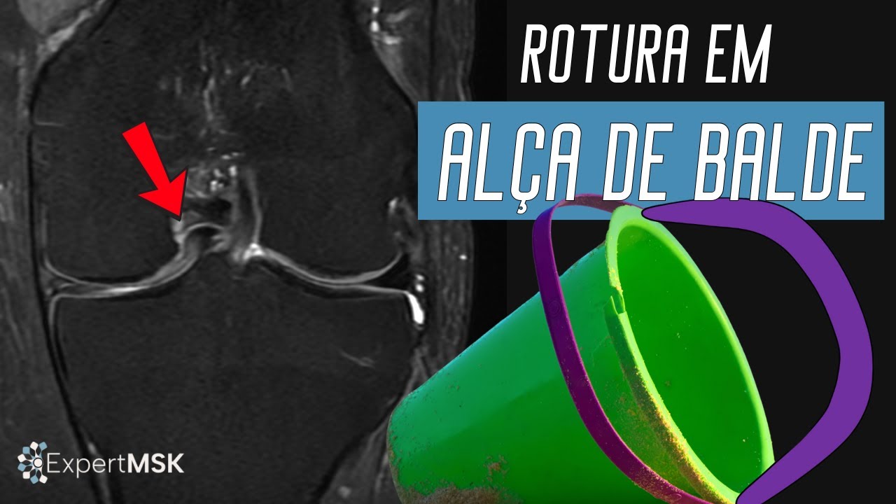 rotura-em-al-a-de-balde-no-menisco-medial-youtube