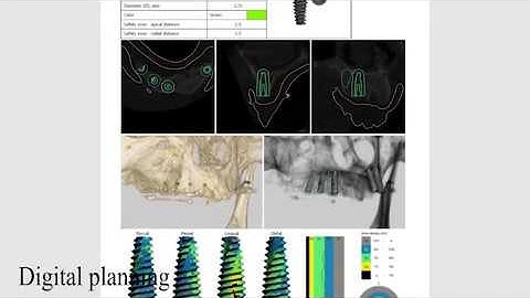 Fully guided implant surgery with paltop kit and pca implants