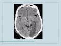 Clinical Pearls in Cerebrovascular Disease Neurology