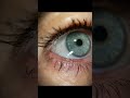 Scleral lens fitting with QuikVue adaptor from VisuScience