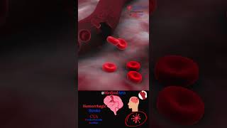 Hemorrhagic Stroke 🧠 Cva - Medical Arts 3D Animation