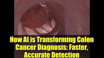 How AI is Transforming Colon Cancer Diagnosis: Faster, Accurate Detection