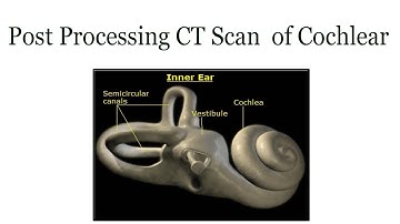 CT Scan  of Cochlear post processing