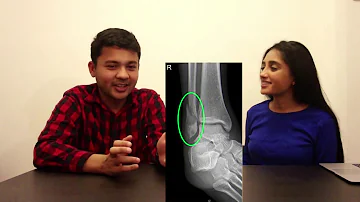 Comment soigner une fracture de la fibula ?