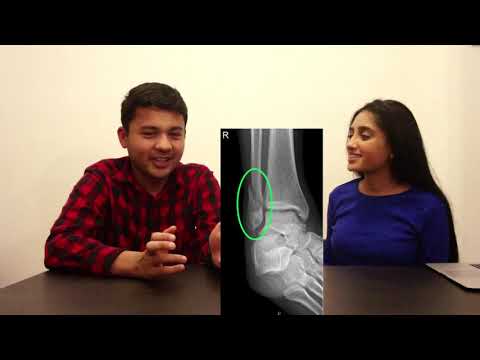 Distal Fibula Fracture