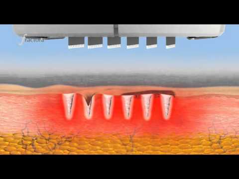 Radiofréquence fractionnée. Cicatrices d'acné, vaisseaux. Dermatologue Pau