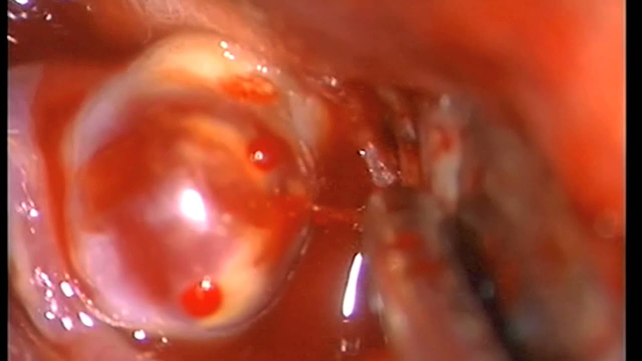 Technical nuances of clipping a middle cerebral artery bifurcation aneurysm