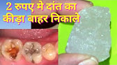 अगर दांत मे कीडा है तो ठीक कर सकते है, cavities in teeth | aaosikhe - YouTube