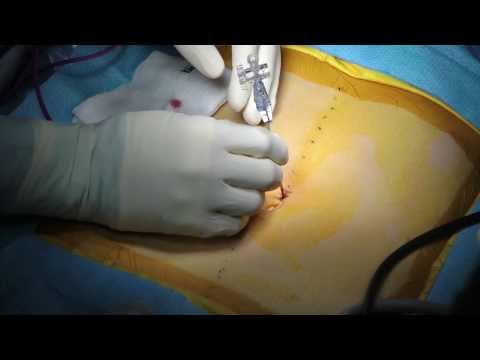 Minimally Invasive Surgery for Crohn&rsquo;s Disease at The Mount Sinai Hospital