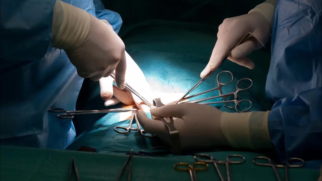 Хирургическое лечение дисплазии тазобедренного сустава - YouTube