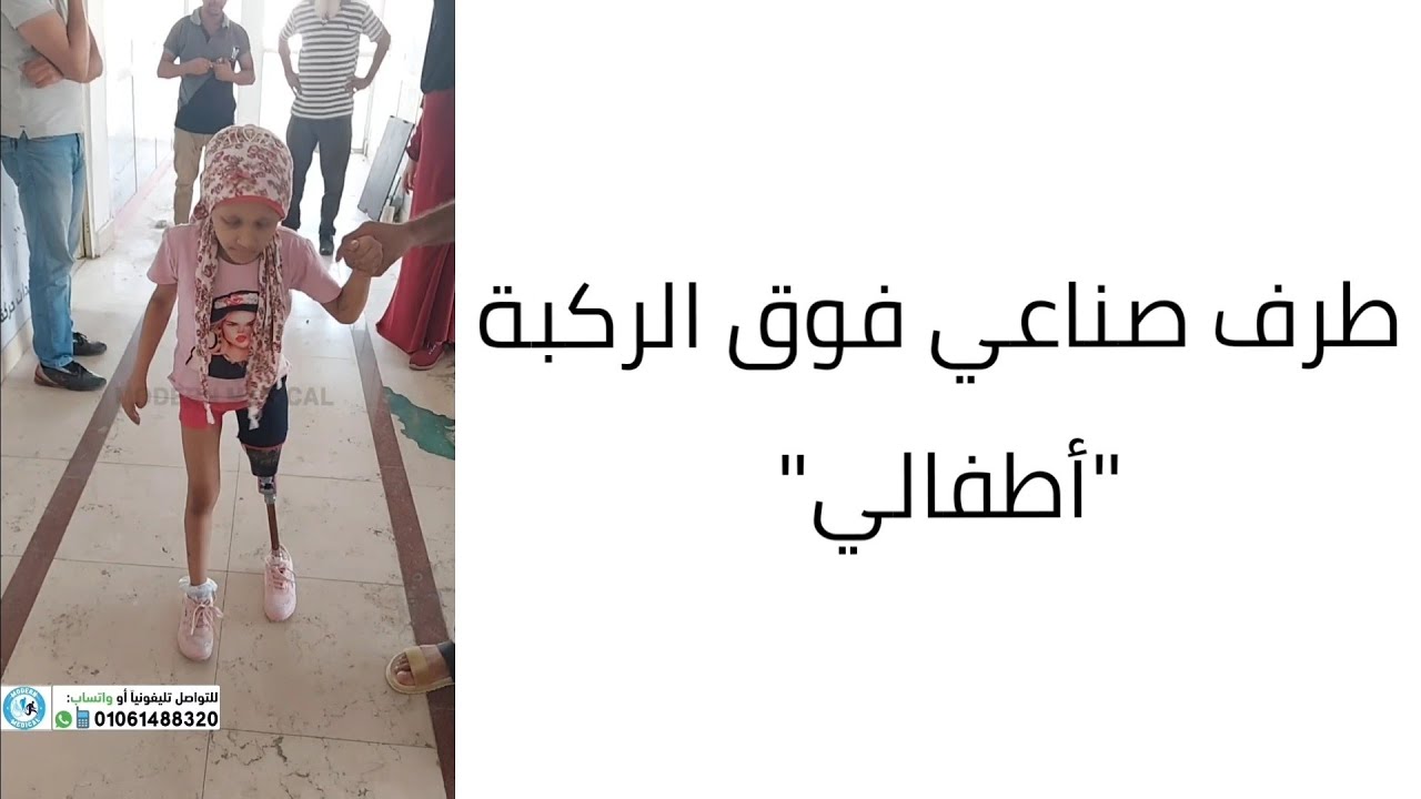 طرف صناعي فوق الركبة موديلر (صيني 🇨🇳) أطفالي