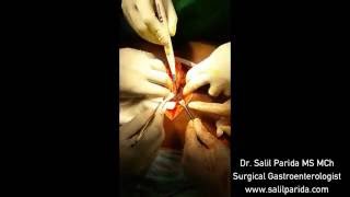 Partial Sacrectomy (S2, S3, S4 & S5) For Giant Sacral Tumor