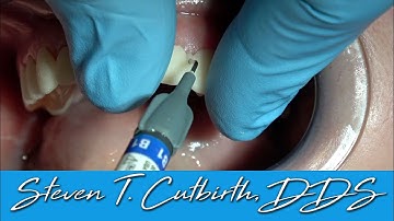 Separating Long Provisionals - Dental Minute with Steven T. Cutbirth, DDS
