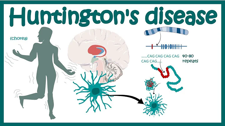 Huntington's Disease | Pathology of Huntington's Chorea | Diagnosis of Huntington's disease - DayDayNews