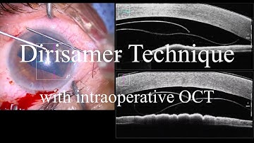Demonstration of Dirisamer DMEK unfolding technique with intraoperative OCT