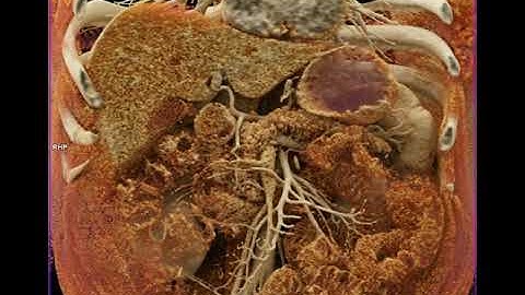 Pancreatic Cancer with Preop Staging with Cinematic Rendering