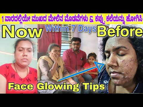 How To Remove Pimples in 1 Week, Remove Dark & Black Spots, Acne Treatment, Ayurveda Beauty Tips, M2