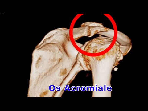 Video: Dab tsi ua rau OS Acromiale?