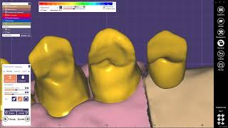 Exocad моделировка каркаса под 3D печать