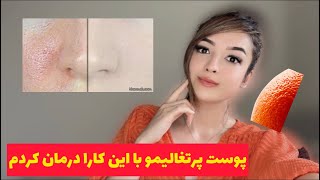 رازهای بستن منافذ باز (پوست پرتقالی)