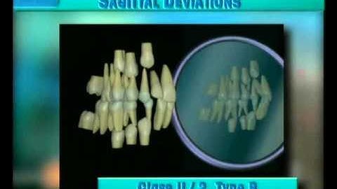 Clip 38: Lateral View of Development in Class II/2 Type B